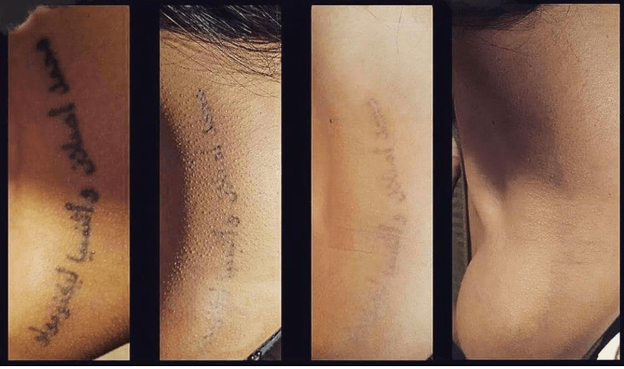 Φωτογραφίες αφαίρεσης τατουάζ πριν και μετά.