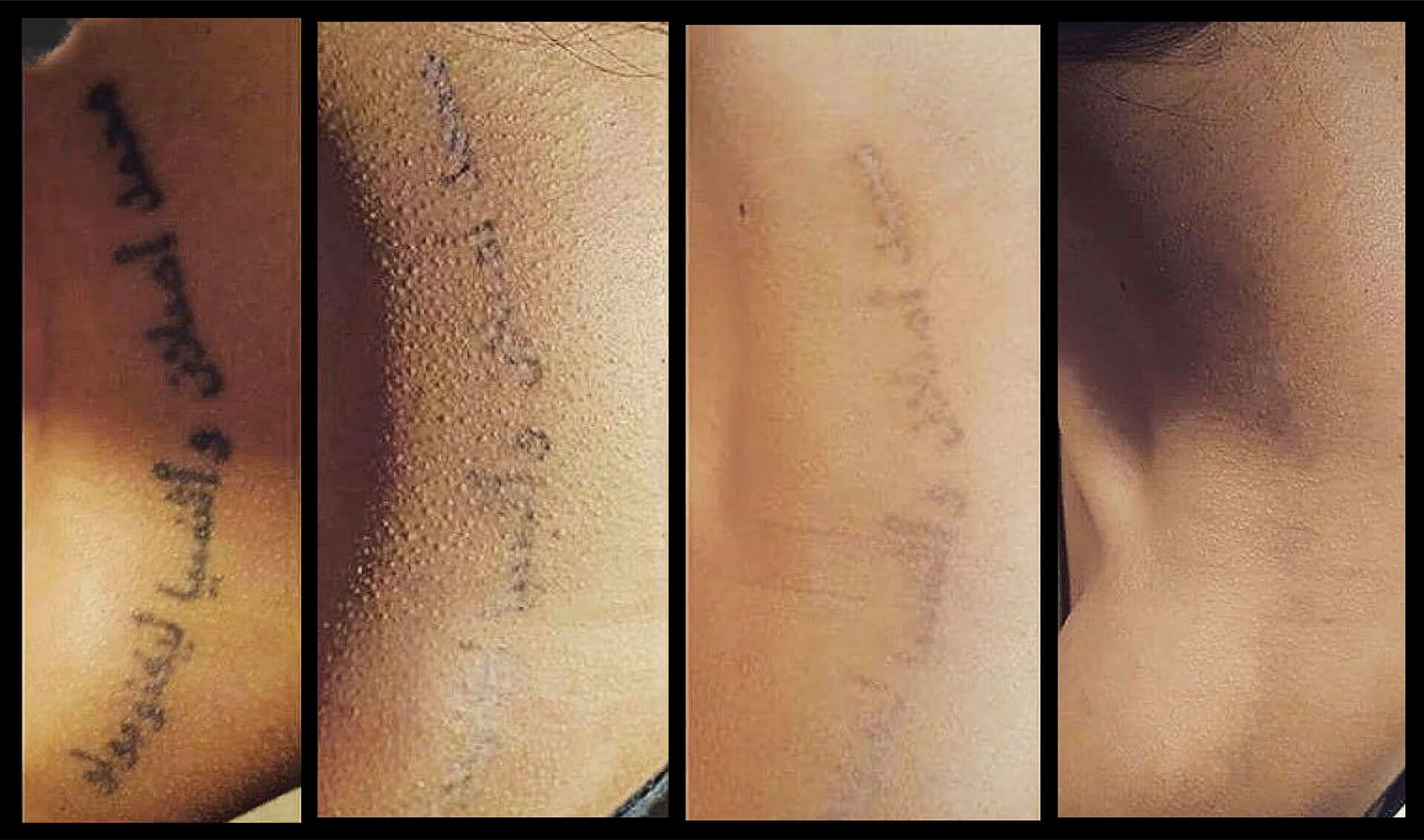 Tattoo Removal at Lucia Clinic 🙌 | Some mistakes are good, and some are  just bad and can irritate you for a long time. 💢 Well, it's time to leave  the past