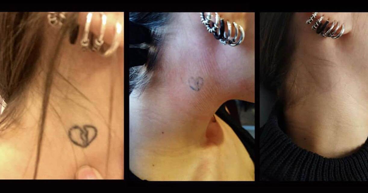Laser Tattoo Removal Cost in Dubai & Abu Dhabi | Price & Deals