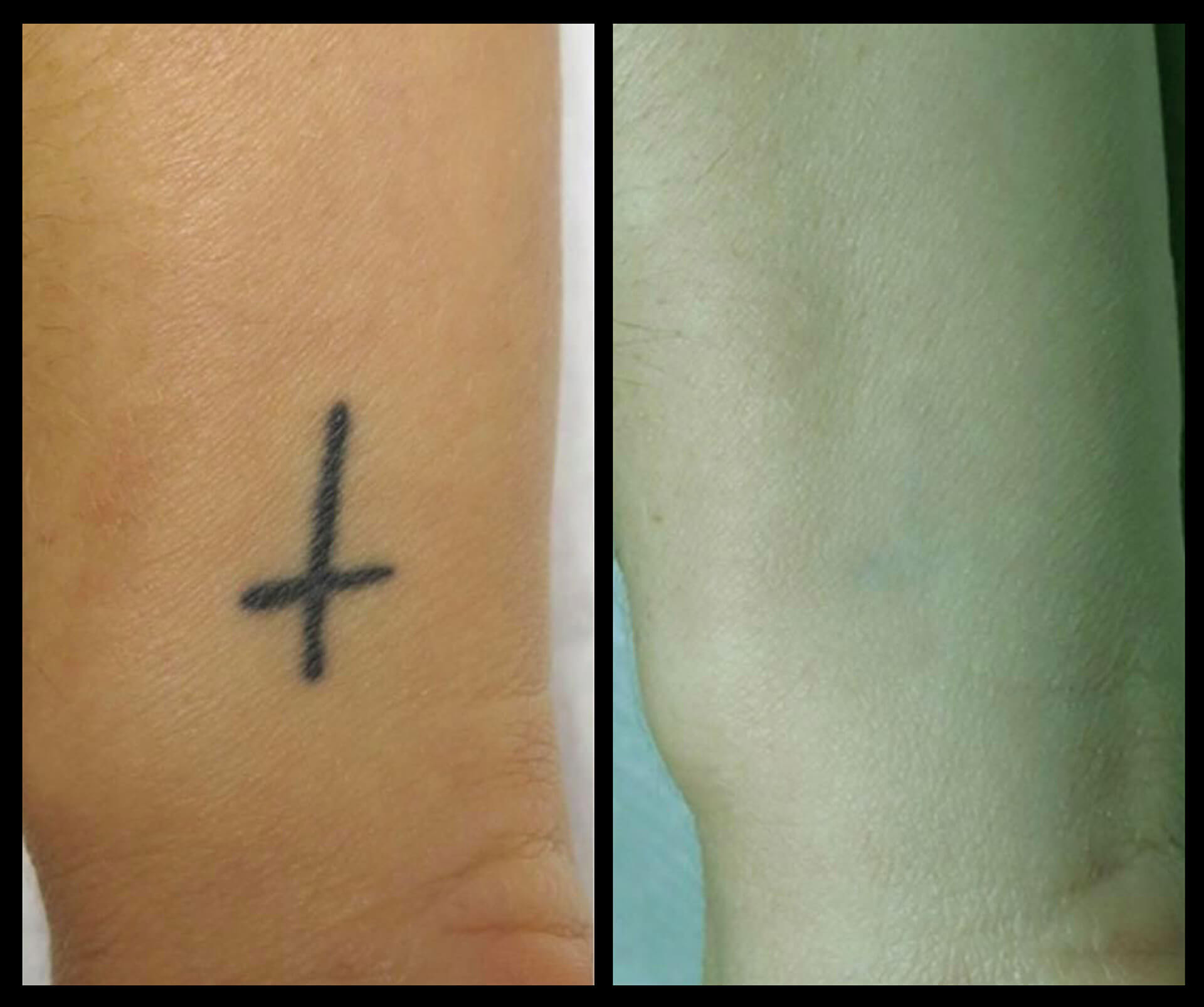 Lauro Paolini Stencil Tattoo Removal – e-tattoo